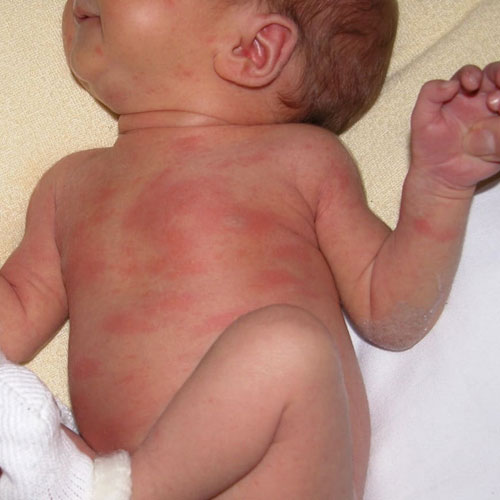 pediatric-allergy